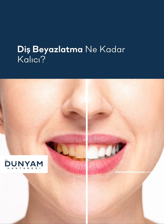 Diş Beyazlatma Sonuçları Ne Kadar Kalıcı?